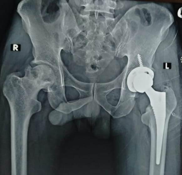 HIP