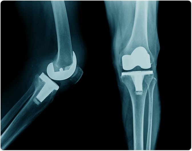 KNEE