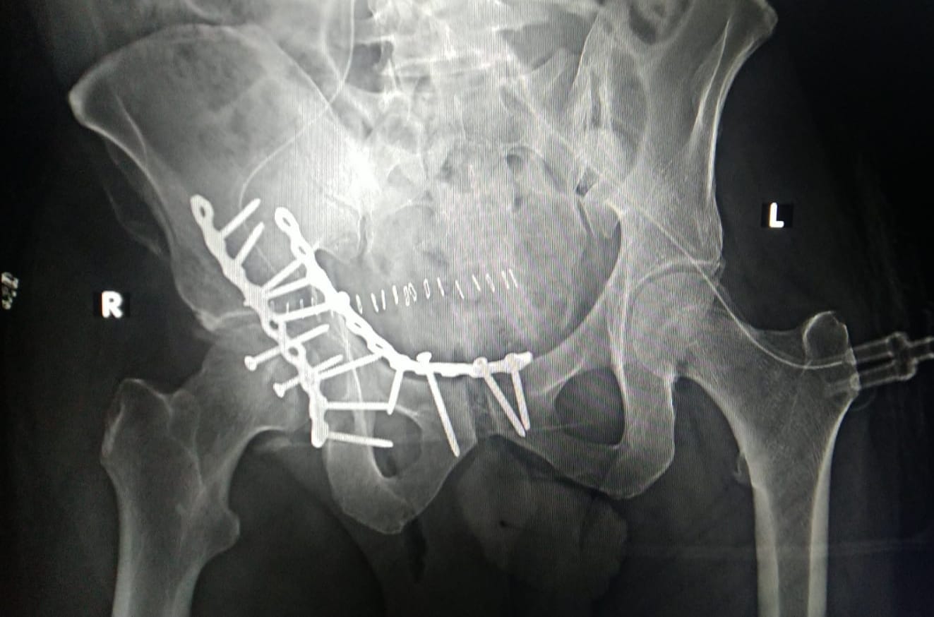 PELVI ACETABULARY INJURY