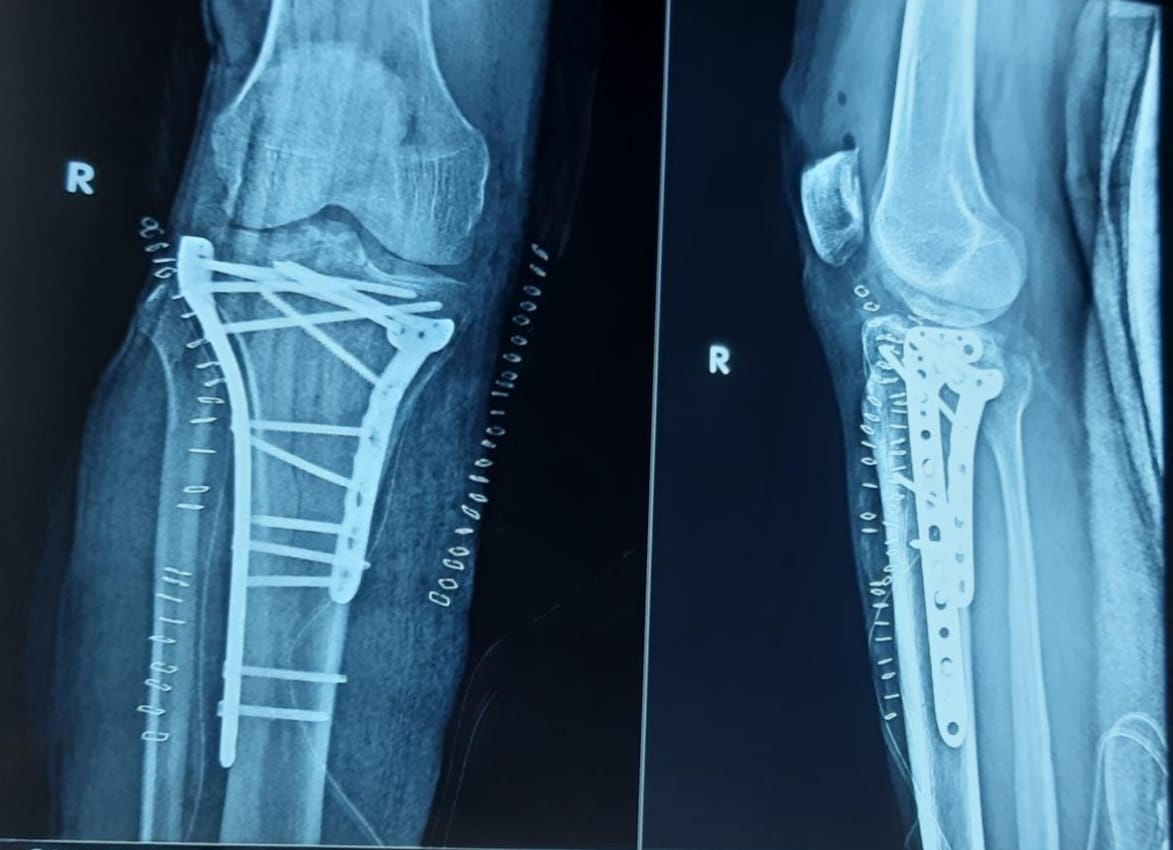 TREATMENT FOR FRACTURES OF LONG BONES